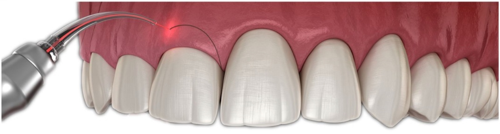 Laser-assisted gummy smile treatment  precise gum contouring