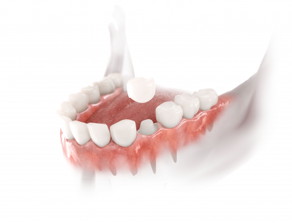 Zirconium crown example for Hollywood Smile treatment at Dentist Kusadasi