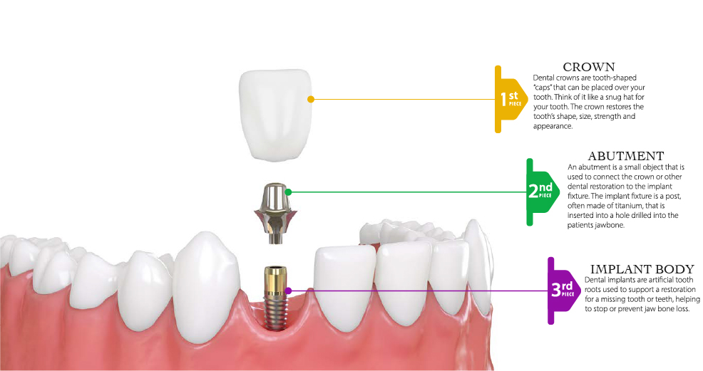 Close-up of titanium dental implant surface texture
