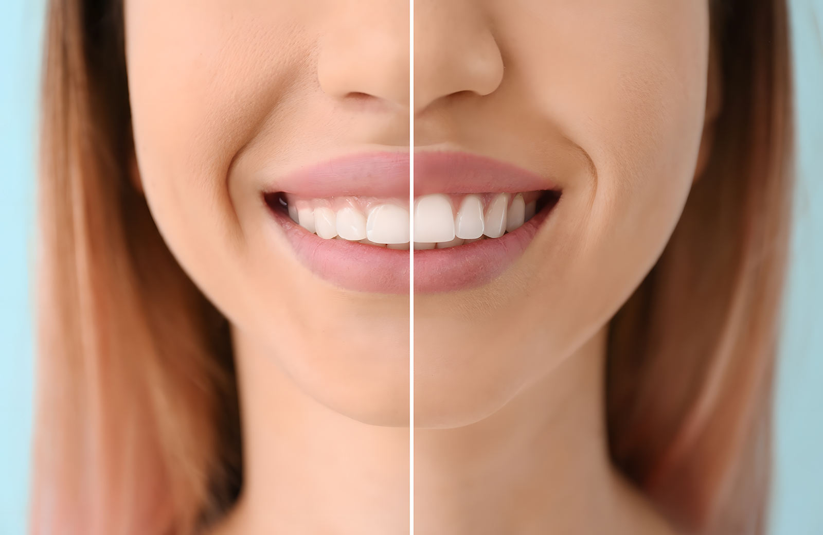 Gummy smile correction before-and-after results at Dentist Kusadasi
