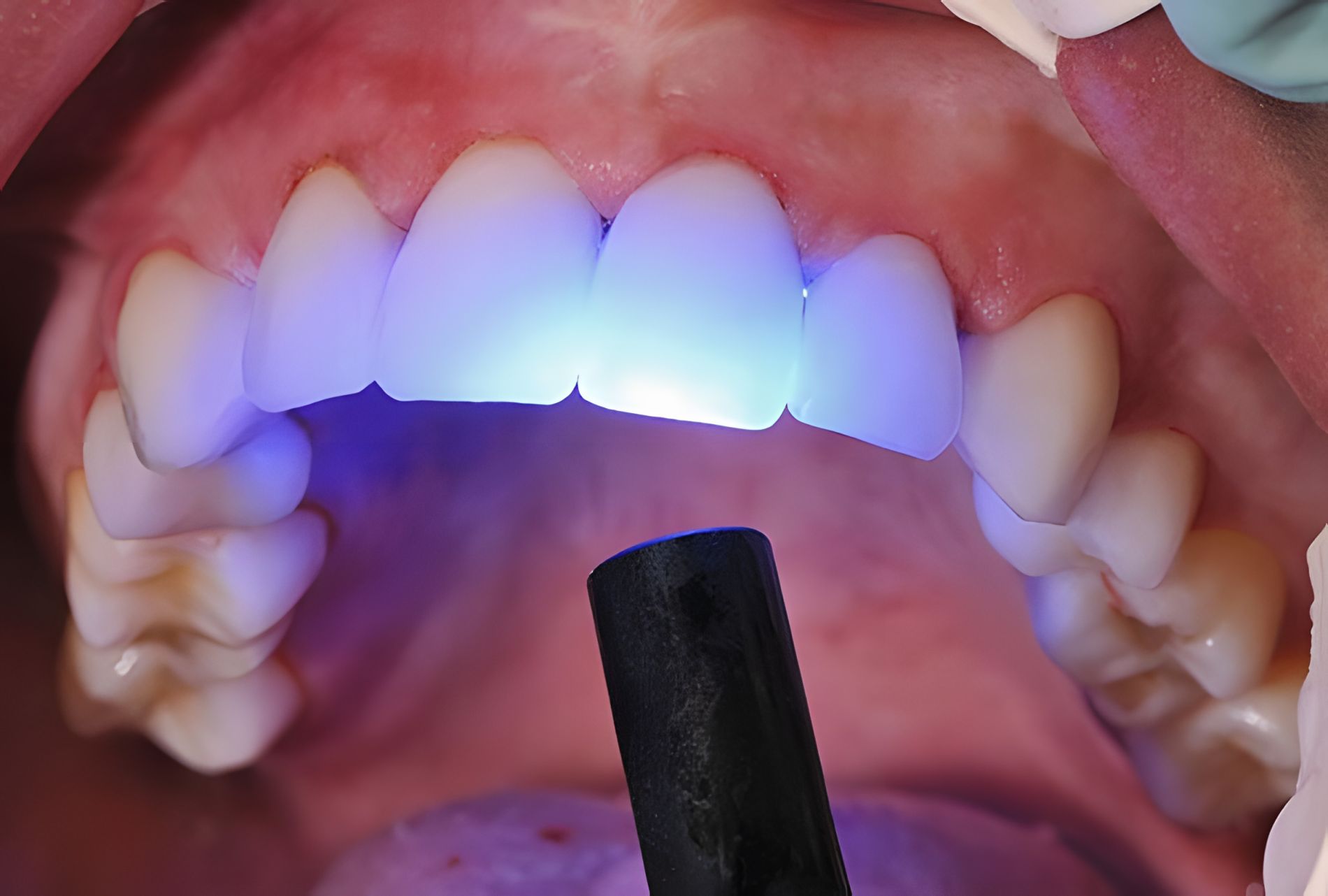 What is composite bonding  tooth-colored resin being applied to a front tooth