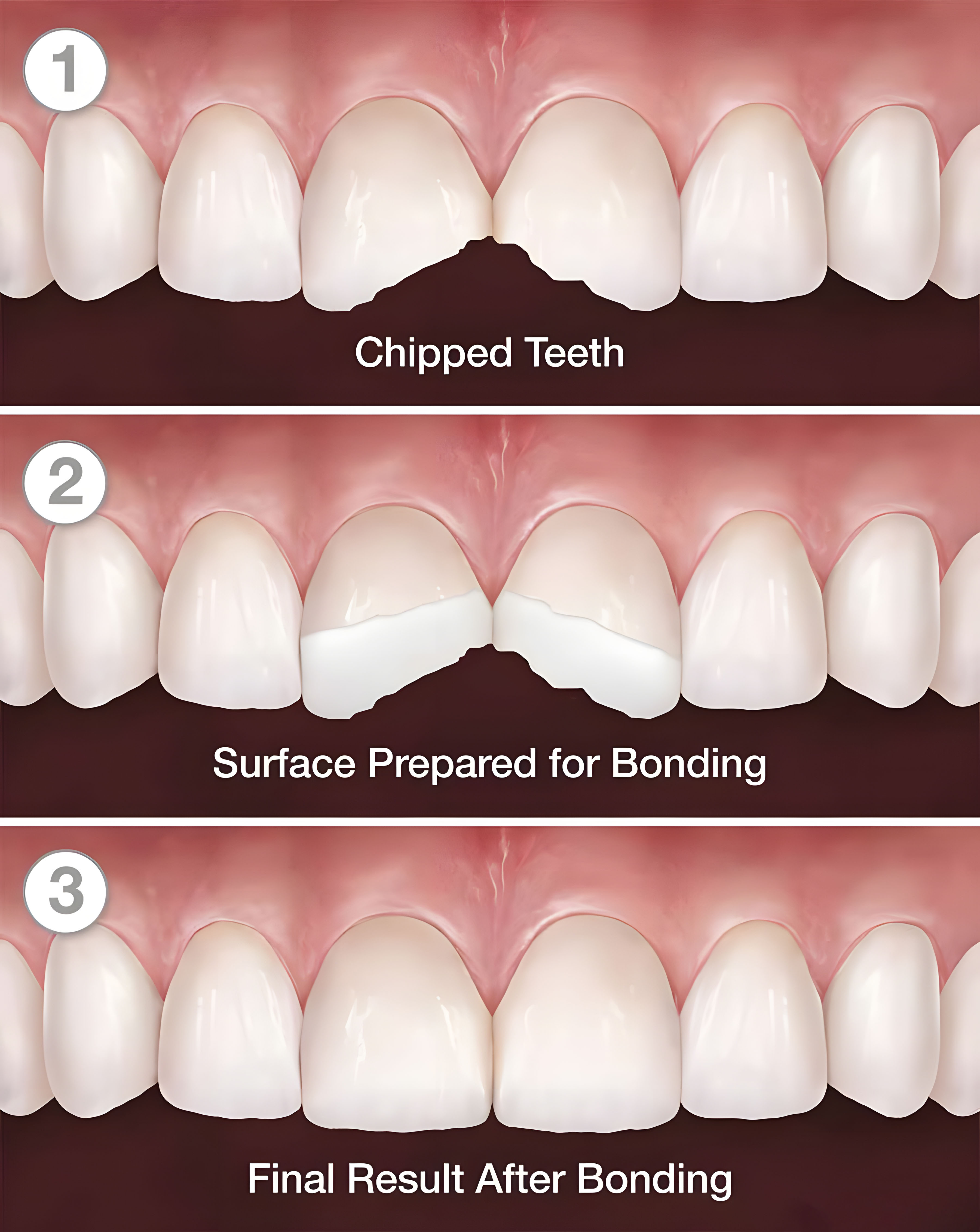 Composite bonding results  natural-looking restoration on front teeth