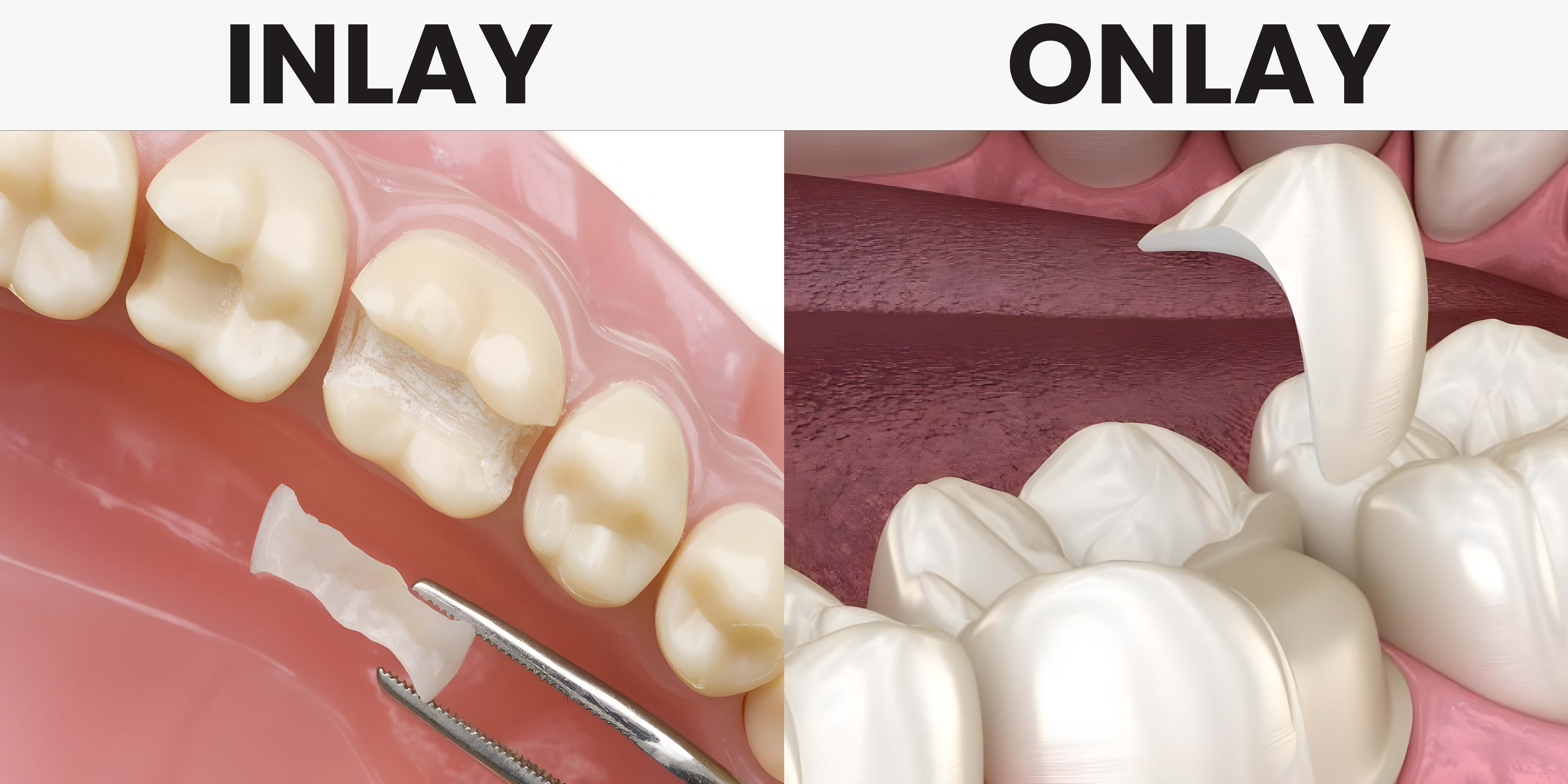 InlayOnlay dental treatment illustration at Dentist Kusadasi