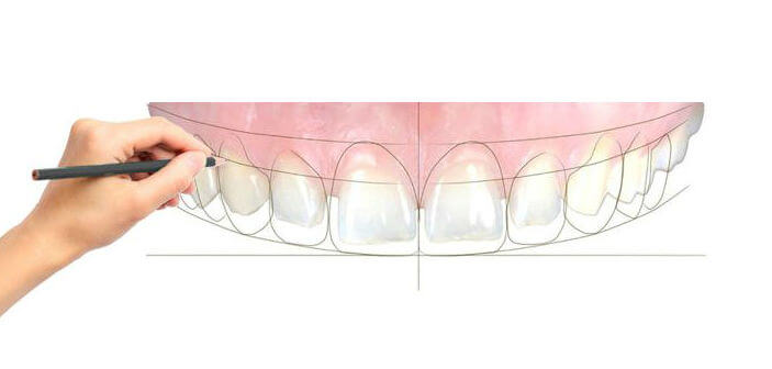 Digital Smile Design for veneers